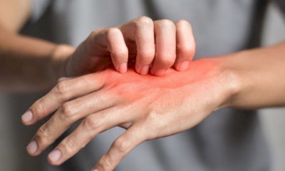 In Italia continua ad aumentare l’allarme per la scabbia