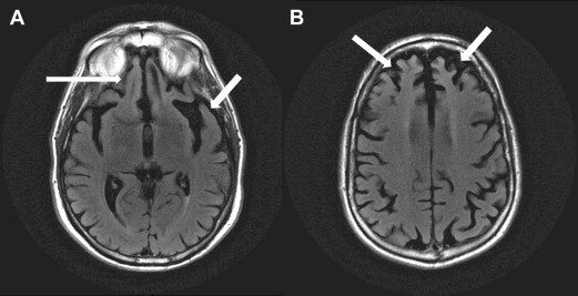Con il farmaco Bezafibrato c'è ora una speranza per contrastare la demenza frontotemporale
