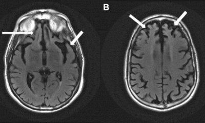 Con il farmaco Bezafibrato c'è ora una speranza per contrastare la demenza frontotemporale